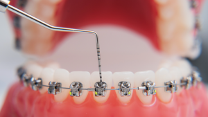 Fio Ortodôntico: Saiba O Que São E Suas Funções - Blog Dental Tiradentes